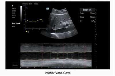 ME8 Portable Ultrasound Machines By Mindray